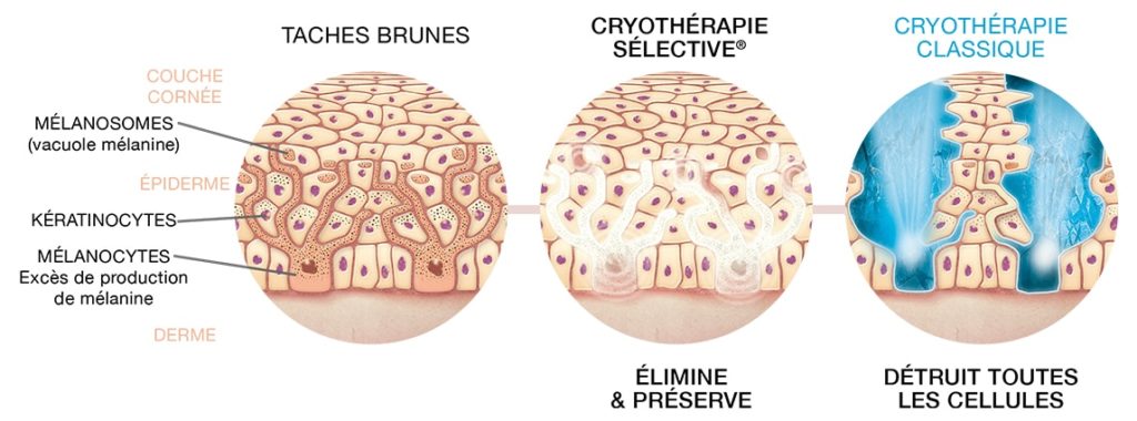 La Cryothérapie pour éliminer les taches brunes - Actu Santé Fenua