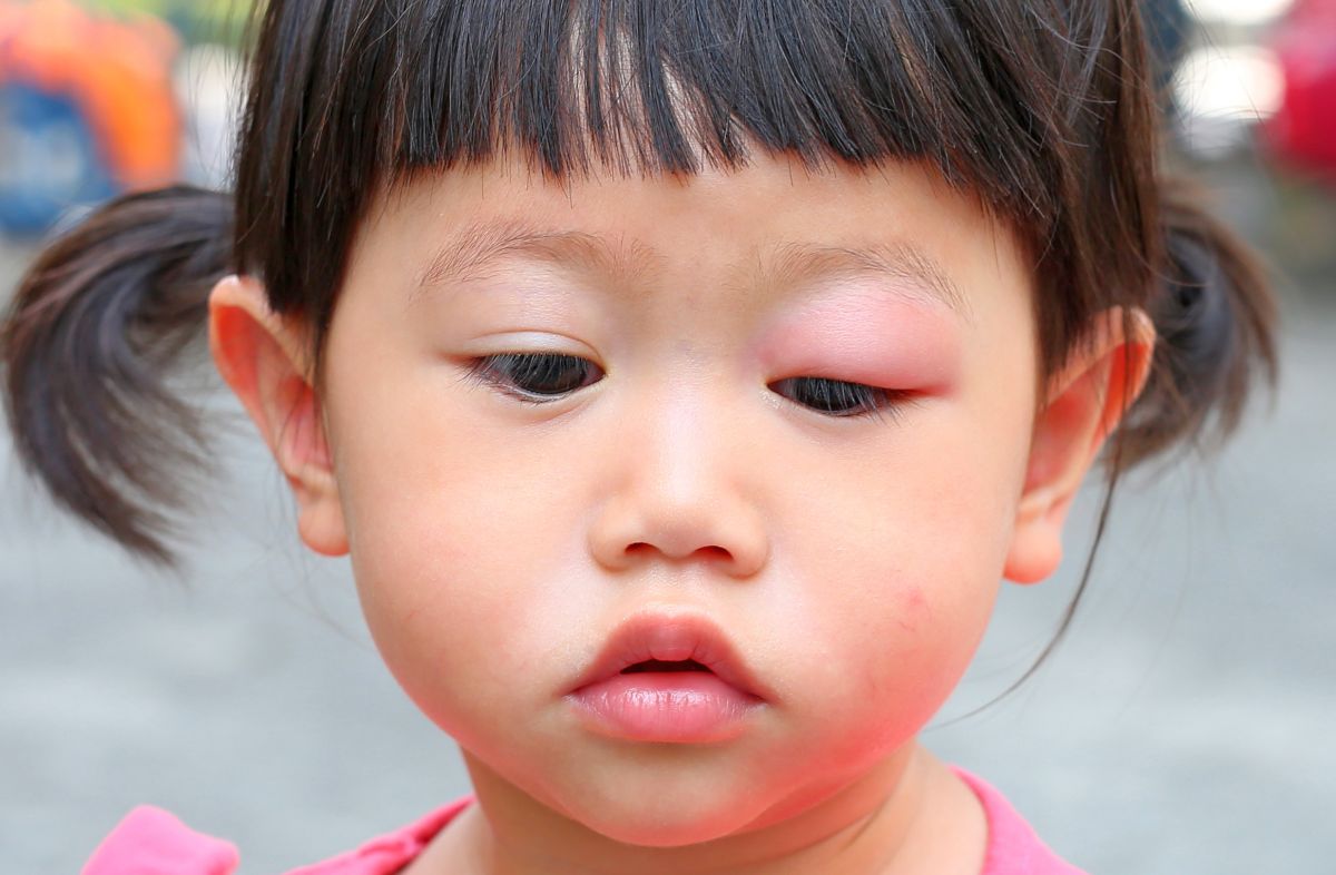 Allergie Piqure De Moustique Actu Sante Fenua